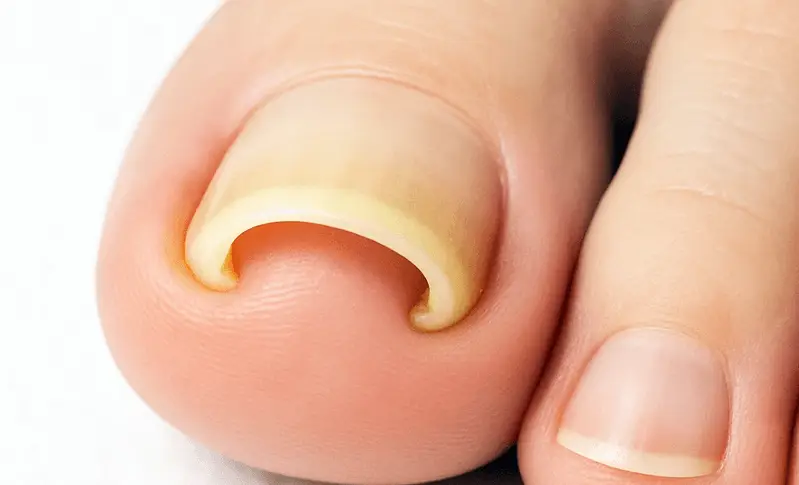 巻き爪を専用プレートで矯正している施術風景